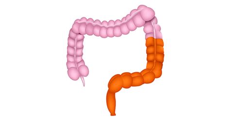 Proctosigmoiditis? | Ulcerative Colitis | IBDrelief