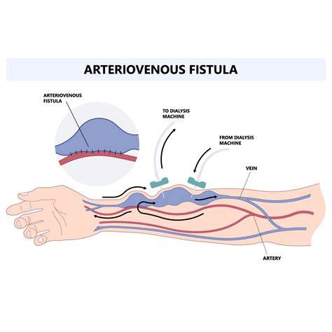 2024 Guide: Arteriovenous Fistula Causes & Cares | Vejthani