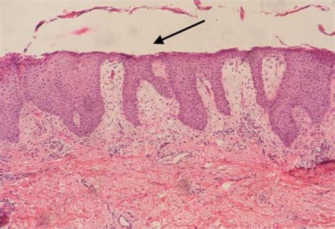 Skin biopsy in necrolytic migratory erythema showing a large zone of ...