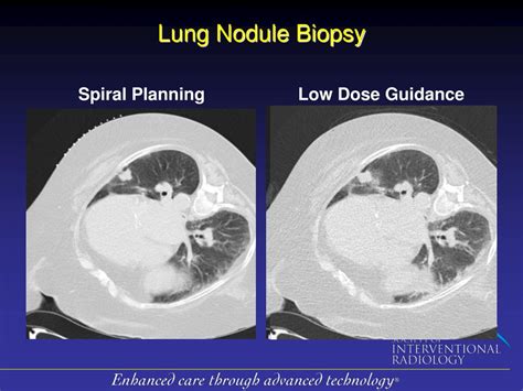 PPT - Lower Dosage CT-guided Lung Biopsy Protocol Maintains Quality, Minimizes Exposure ...