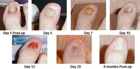 Ingrown Toenail Treatment, Causes & Prevention - Foot Pain Explored