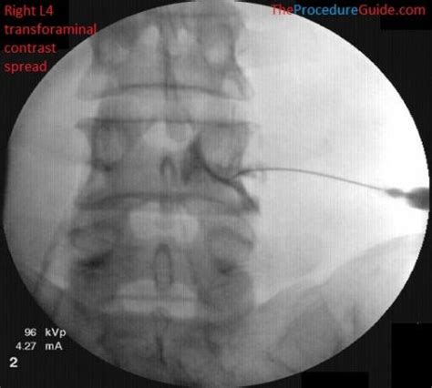 Fluoroscopic Guided Thoracic/Lumbar Transforaminal Epidural Steroid Injection - Technique and ...