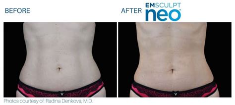 Emsculpt NEO Before and After | Real Patient Results