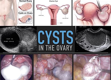 Ovarian Cyst Clinic in Singapore | Dr Anthony Siow