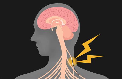 [WEB] Common Questions About Vagus Nerve Stimulation | TBI Rehabilitation