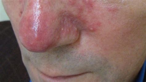 Rosacea: skin condition may warn of serious diseases – RCI | English