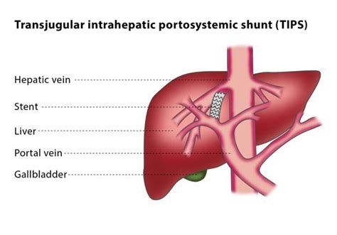 Transjugular intrahepatic portosystemic shunt (TIPS) – CIRSE | Tips procedure, Tips, Enlarged veins