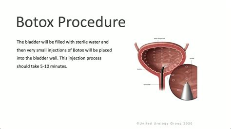 Patient Counseling - Botox for the Treatment of Overactive Bladder ...