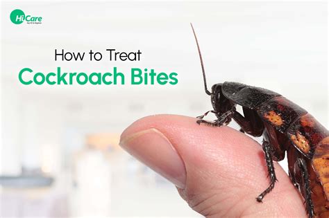 Cockroach Bite : Check Symptoms, Treatment and Prevention Tips