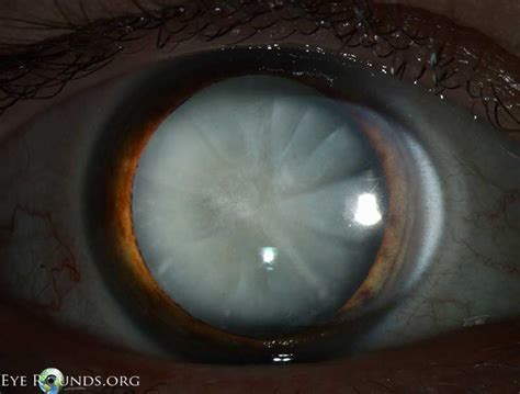 Atlas Entry - Mature cortical cataract