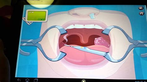 Operate now tonsil surgery - YouTube