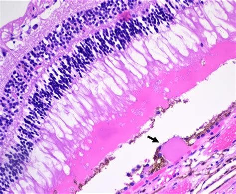 Histology Of Choroid Of Eye