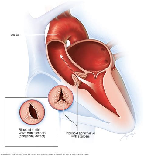 Aortic valve stenosis - Mayo Clinic