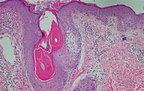 Follicular Mucinosis Histology