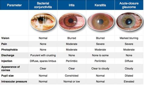 iritis vs conjunctivitis vs keratitis