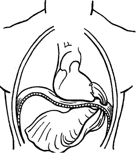 O'Shaughnessy's illustration of a cardio-omentopexy. | Download ...