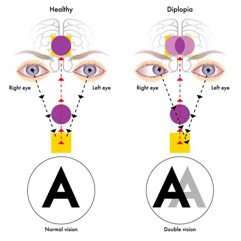 Things You Should Know About Diplopia Titan Eyeplus Blog, 50% OFF