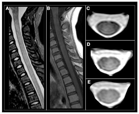 Cervical Spine Mri Ms