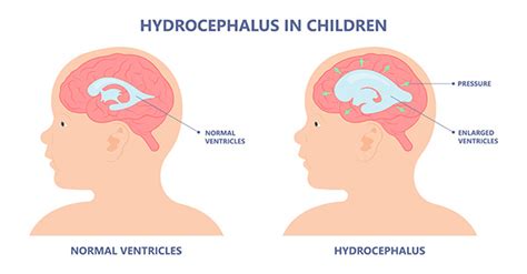 Hydrocephalus | Diagnosis, Symptoms, Treatment & More | CHOC