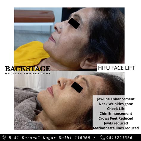 HIFU Treatment Non Surgical Facelift | Dr Geeta Arora | Backstage Delhi