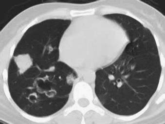 Benign Lung Tumors | Thoracic Key