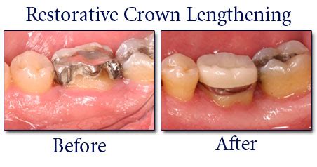 Crown Lengthening Surgery | Periodontal Gum Surgery