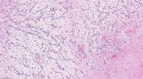 Nasopharyngeal Angiofibroma Histology