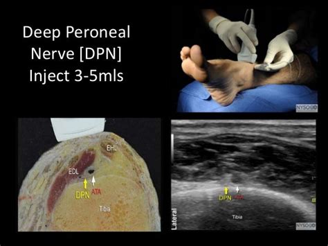 Ultrasound guided ankle block