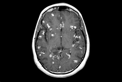 Leukoencephalopathies: (White) Matters of Concern