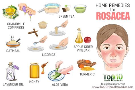 Home Remedies for Rosacea | Top 10 Home Remedies