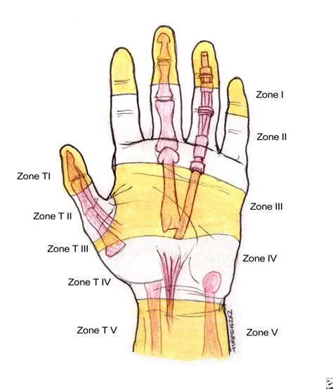 Flexor Tendon Zones of Hand | Bone and Spine | Hand therapy, Infant lesson plans, Hand injuries