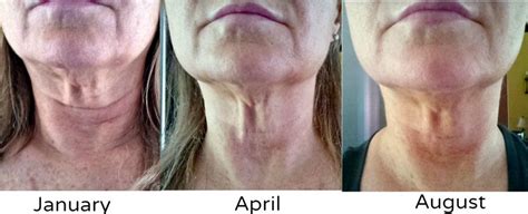 Get Rid of Turkey Neck: How I Tightened Saggy Skin At-Home. Pictures