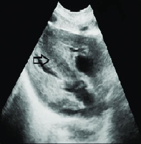 Echocardiography demonstrating asymmetrical hypertrophy of the ...