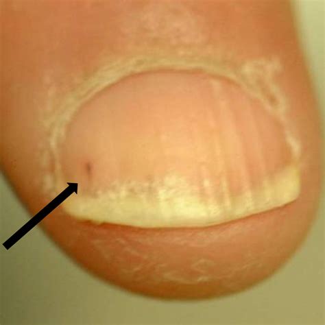 Psoriasis Fingernails In Holes