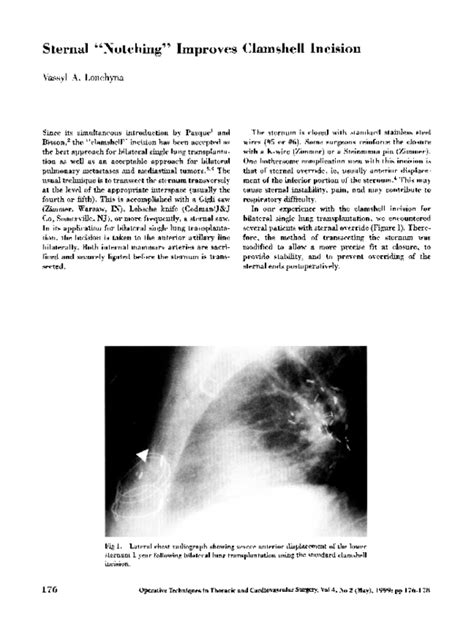 (PDF) Sternal “Notching” Improves Clamshell Incision | Vassyl Lonchyna - Academia.edu