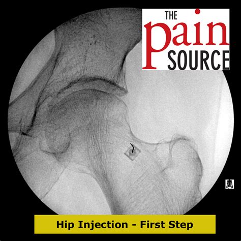 Hip Joint Injection With Fluoroscopy - Technique and Tips ...