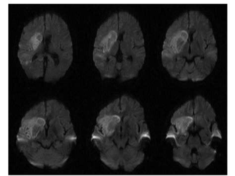 Figure 3 from Diagnosis of Rhinocerebral Mucormycosis by Treatment of ...