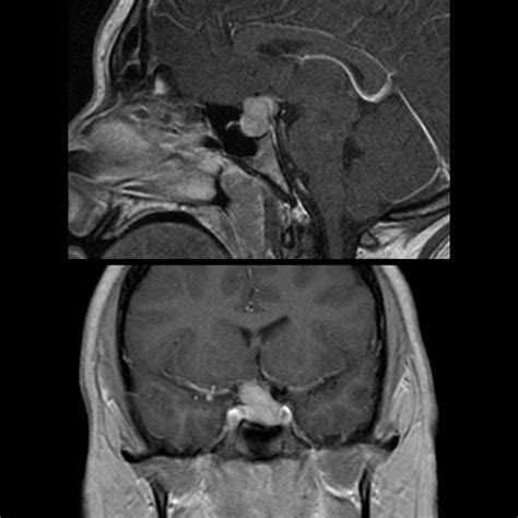 Pediatric Pituitary Macroadenoma | Pediatric Radiology Reference ...