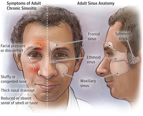 Adult Chronic Sinusitis | Allergy and Clinical Immunology | JAMA | The ...