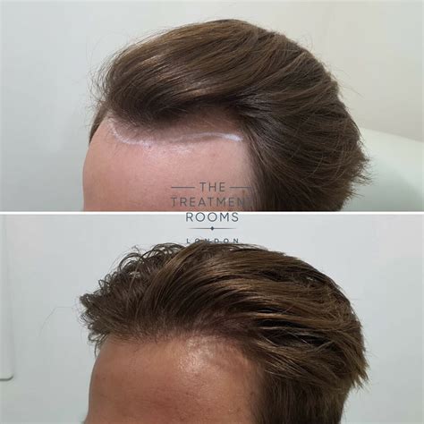 Receding Hairline & Hairline Transplant | Treatment Rooms London