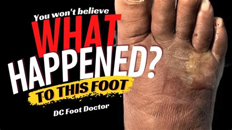 What Happened?: Abscess and Foreign Body of the Foot - YouTube