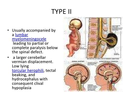 Crazy Mommy: Day 2 and all about Chiari Malformation.