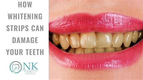 How Whitening Strips Can Damage Your Teeth - NK Family Dental