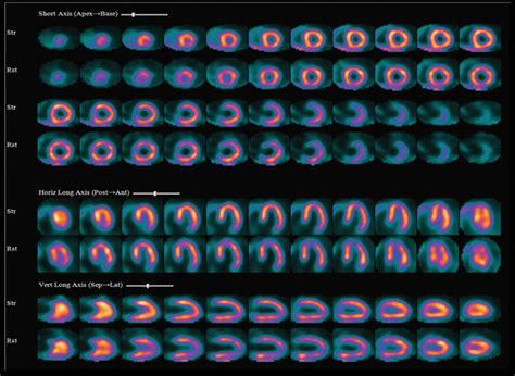 35 Diaphragmatic Attenuation Artifact | Radiology Key