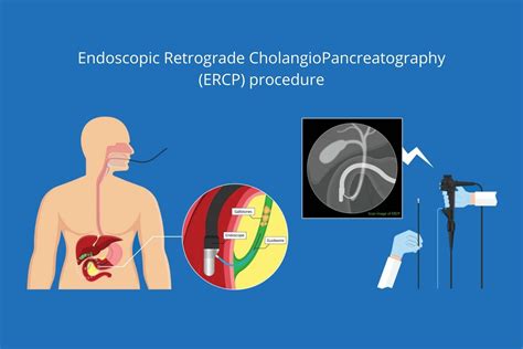 Endoscopic Retrograde CholangioPancreatography (ERCP) procedure