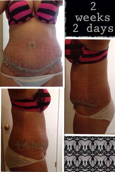 Reverse tummy tuck before and after 2 weeks 2 days » Tummy Tuck: Prices, Photos, Reviews, Info, Q&A