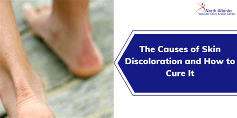 The Causes of Skin Discoloration and How to Cure It