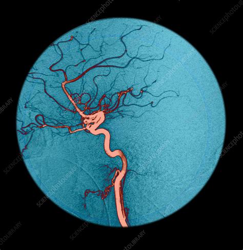 Internal Carotid Artery, Angiogram - Stock Image - C007/5819 - Science Photo Library