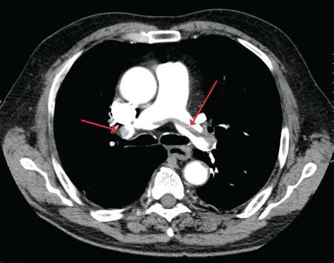 How to manage submassive pulmonary embolism - The Hospitalist