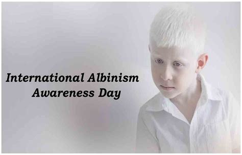 Albinism: Symptoms and Causes | Blogdoxbox.com